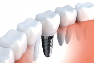 Implant nha khoa (Làm răng giả)